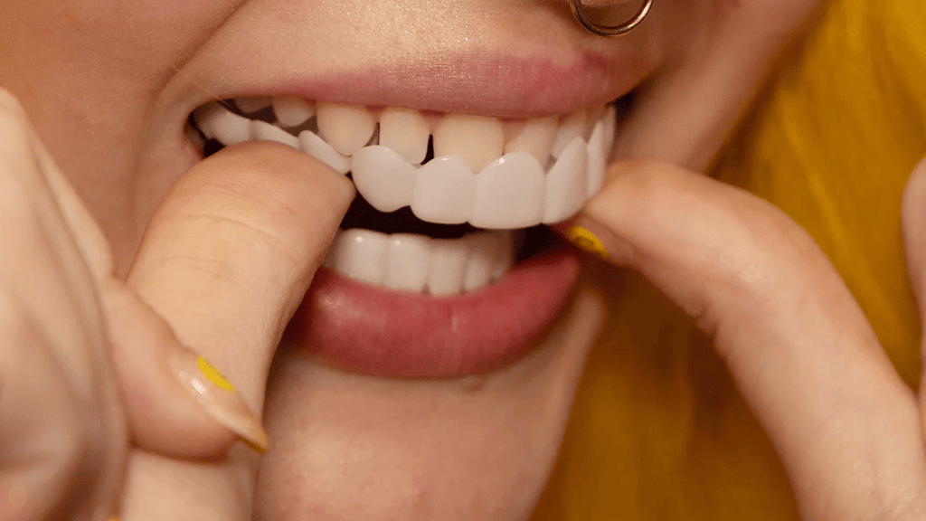 Veneers Snap on Smile (Supérieur & Inférieur)