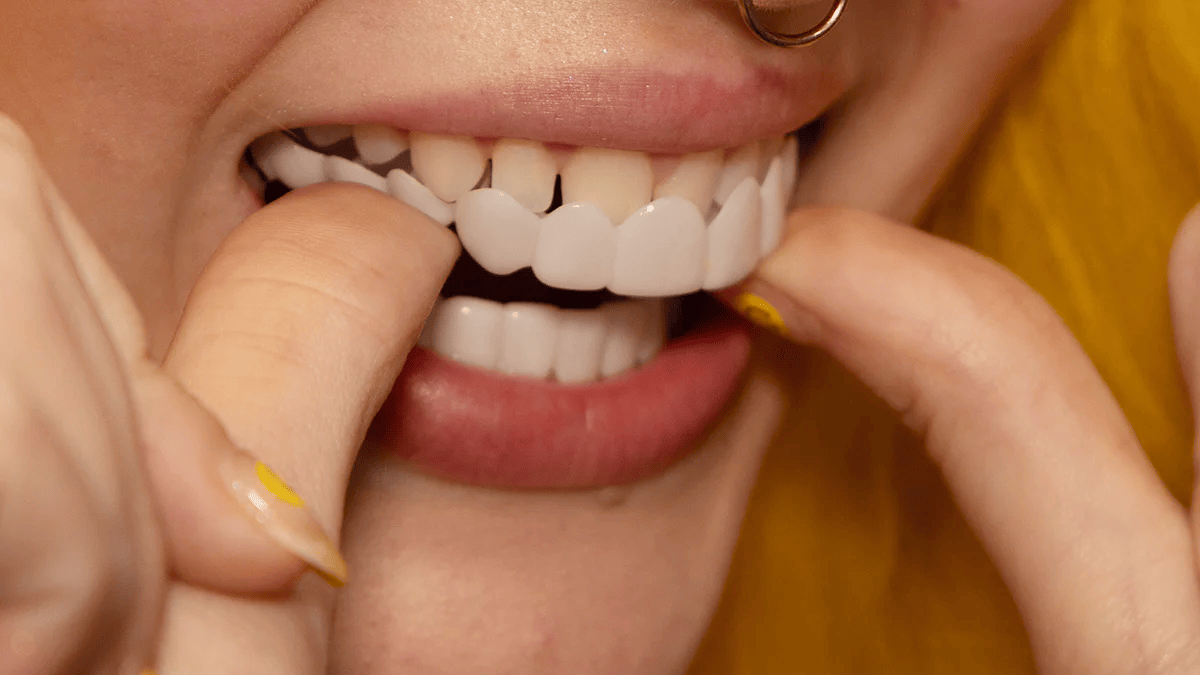 Veneers Snap on Smile (Supérieur & Inférieur)
