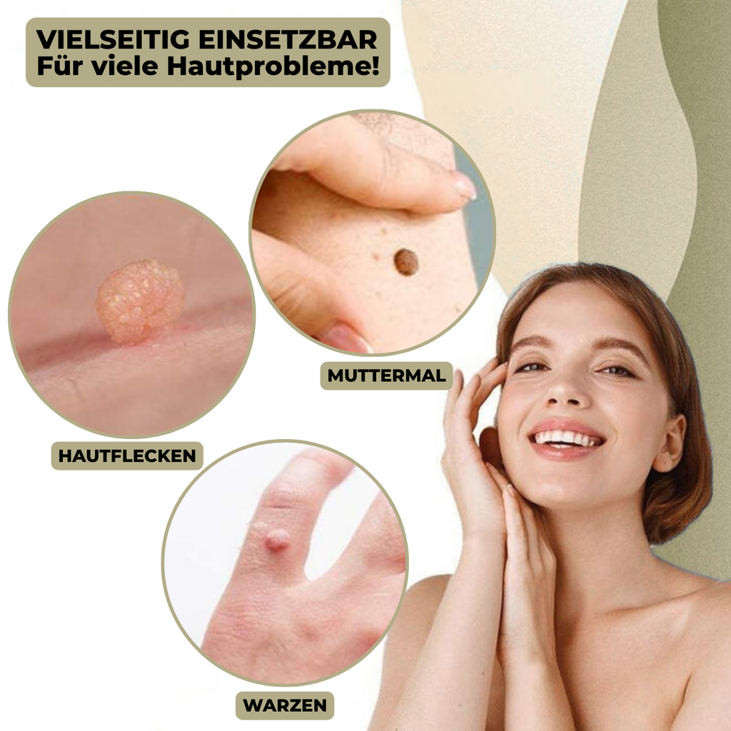 DermaLinx Enlève Verrues | Élimination Indolore des Verrues et Nés | Pour la Maison | Sans Chirurgie