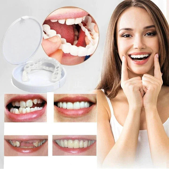 Veneers Snap on Smile (Supérieur & Inférieur)