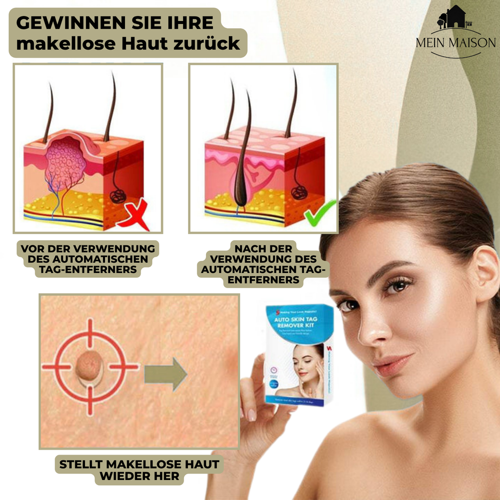 DermaLinx Enlève Verrues | Élimination Indolore des Verrues et Nés | Pour la Maison | Sans Chirurgie