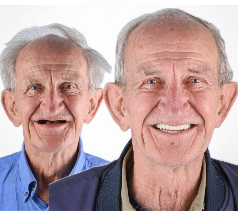 DentalKit - Apparence et sensation naturelles sans le dentiste !
