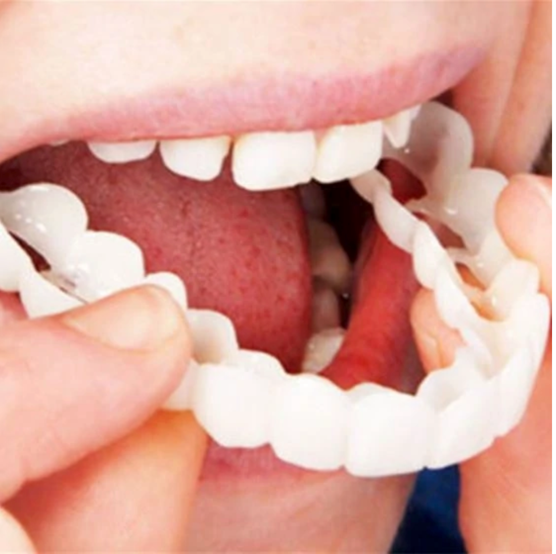 HappySmile Facetset | Facettes supérieures et inférieures réutilisables pour un sourire éclatant