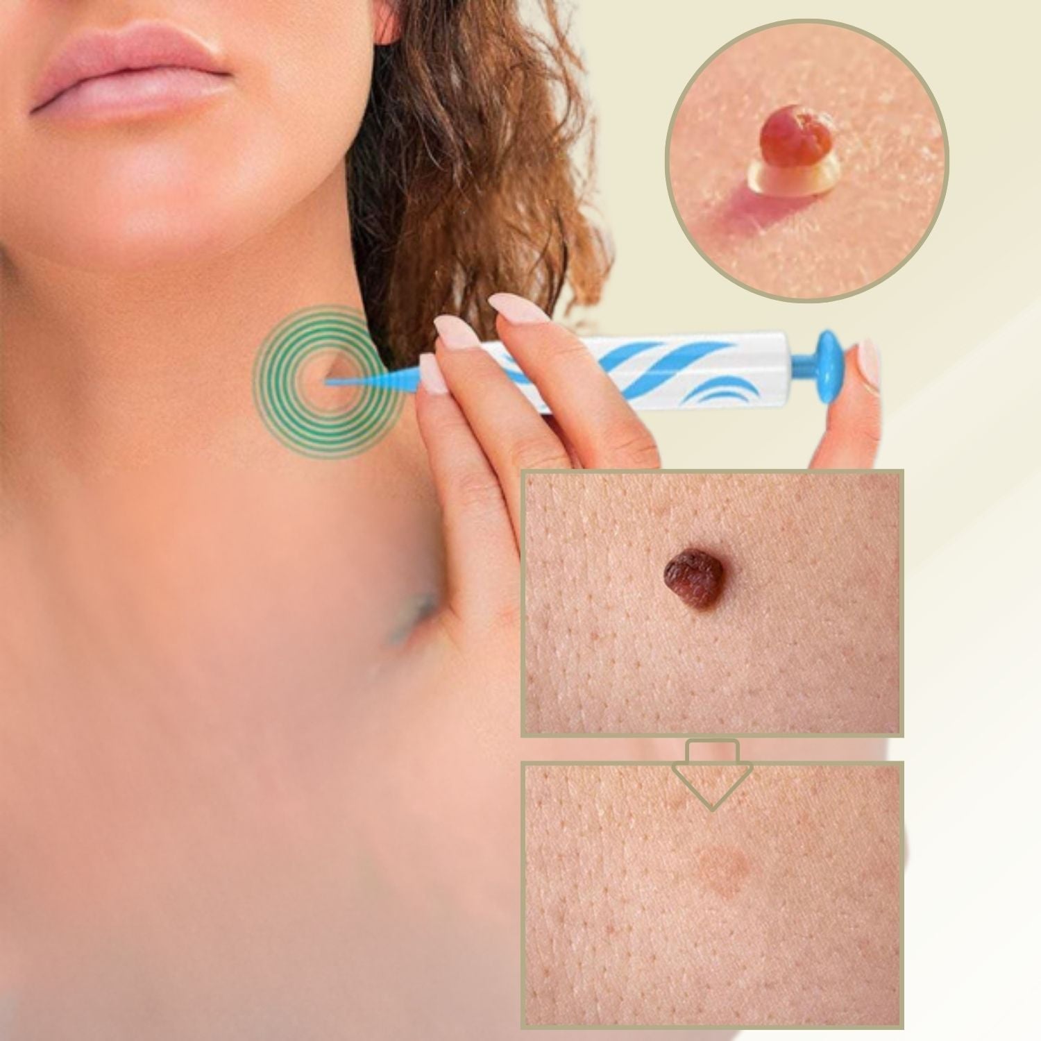 DermaLinx Enlève Verrues | Élimination Indolore des Verrues et Nés | Pour la Maison | Sans Chirurgie