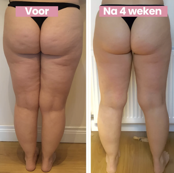 SmoothLift | Traitement Anti-Cellulite & Raffermissement de la Peau