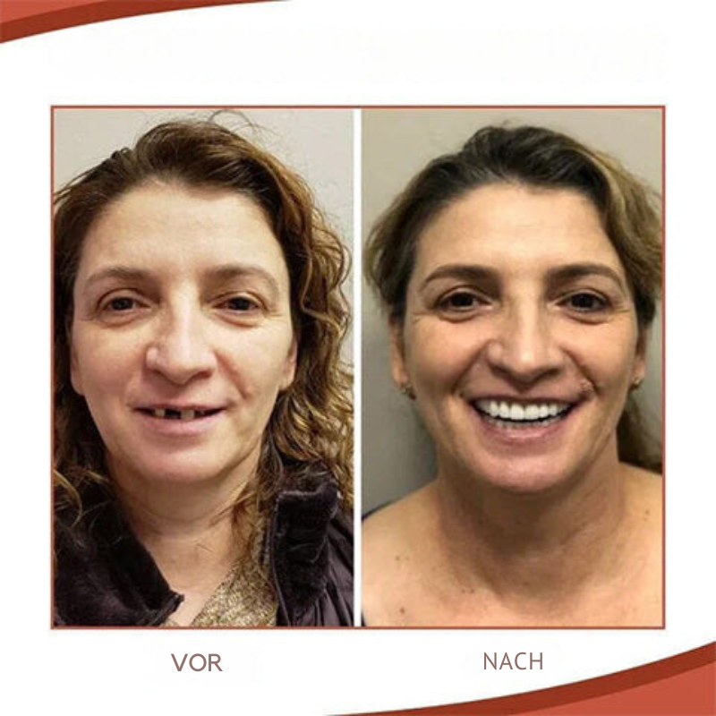 Set de Prothèses en Silicone Biocompatible pour un Ajustement Sans Douleur et un Sourire Naturel