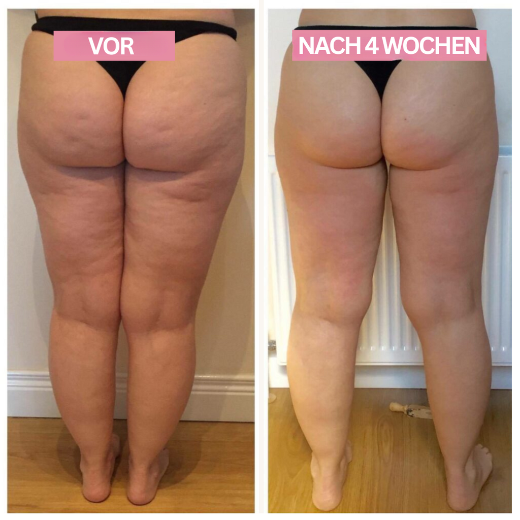Appareil de Cupping Anti-Cellulite – SlimCupp
