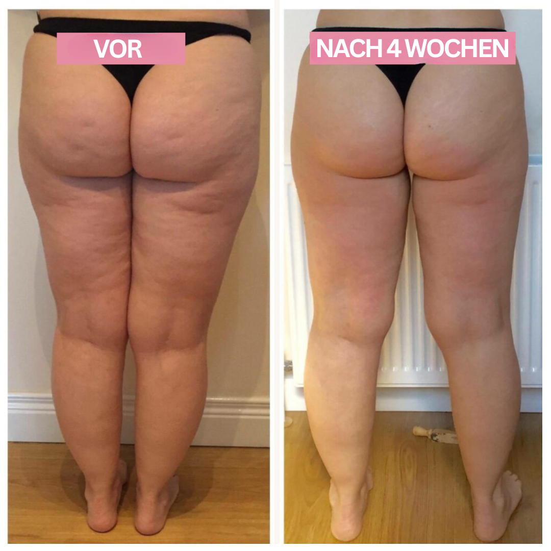 Appareil de Cupping Anti-Cellulite – SlimCupp