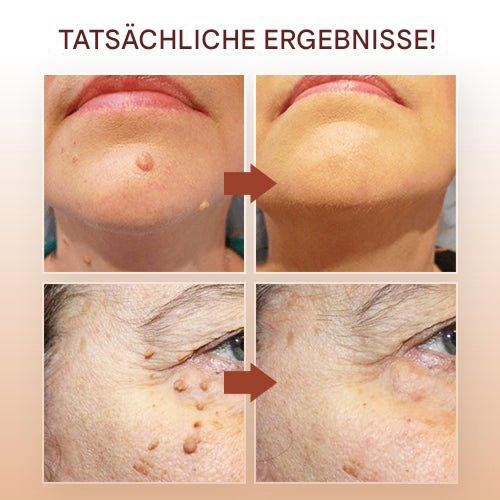 WartOff Éliminateur de Taches de Peau Sans Douleur Formule Naturelle 1 Plus 1 Gratuit