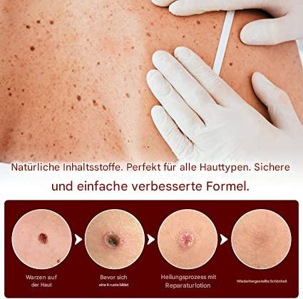WartOff Éliminateur de Taches de Peau Sans Douleur Formule Naturelle 1 Plus 1 Gratuit
