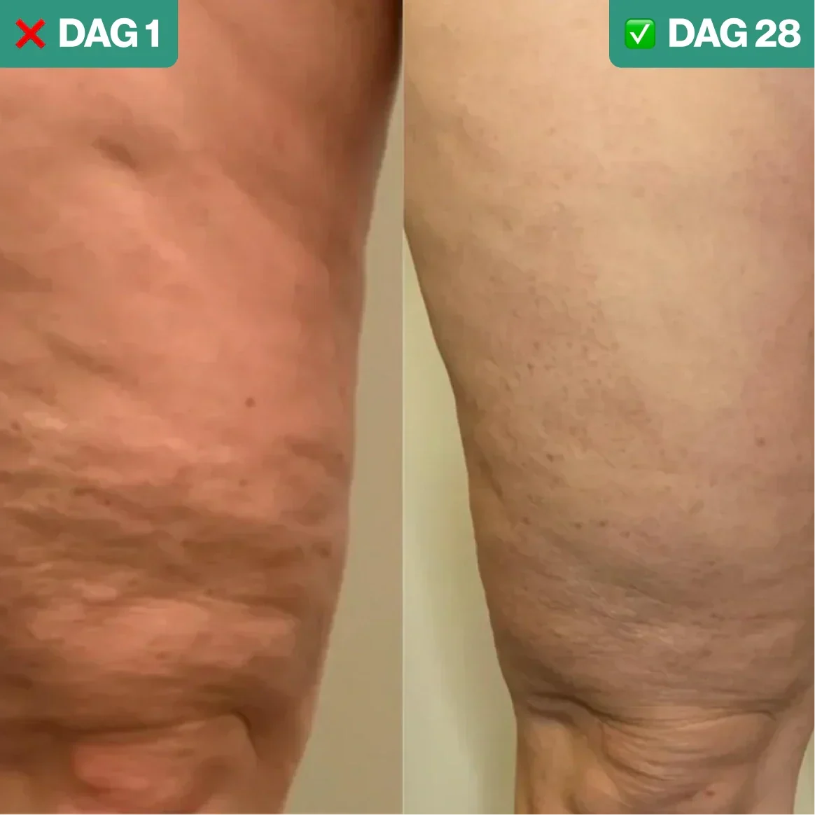 SmoothLift | Traitement Anti-Cellulite & Raffermissement de la Peau