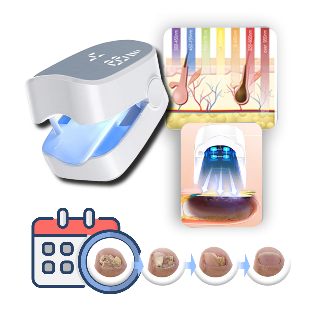 Laser Antifongique des Ongles Indolore