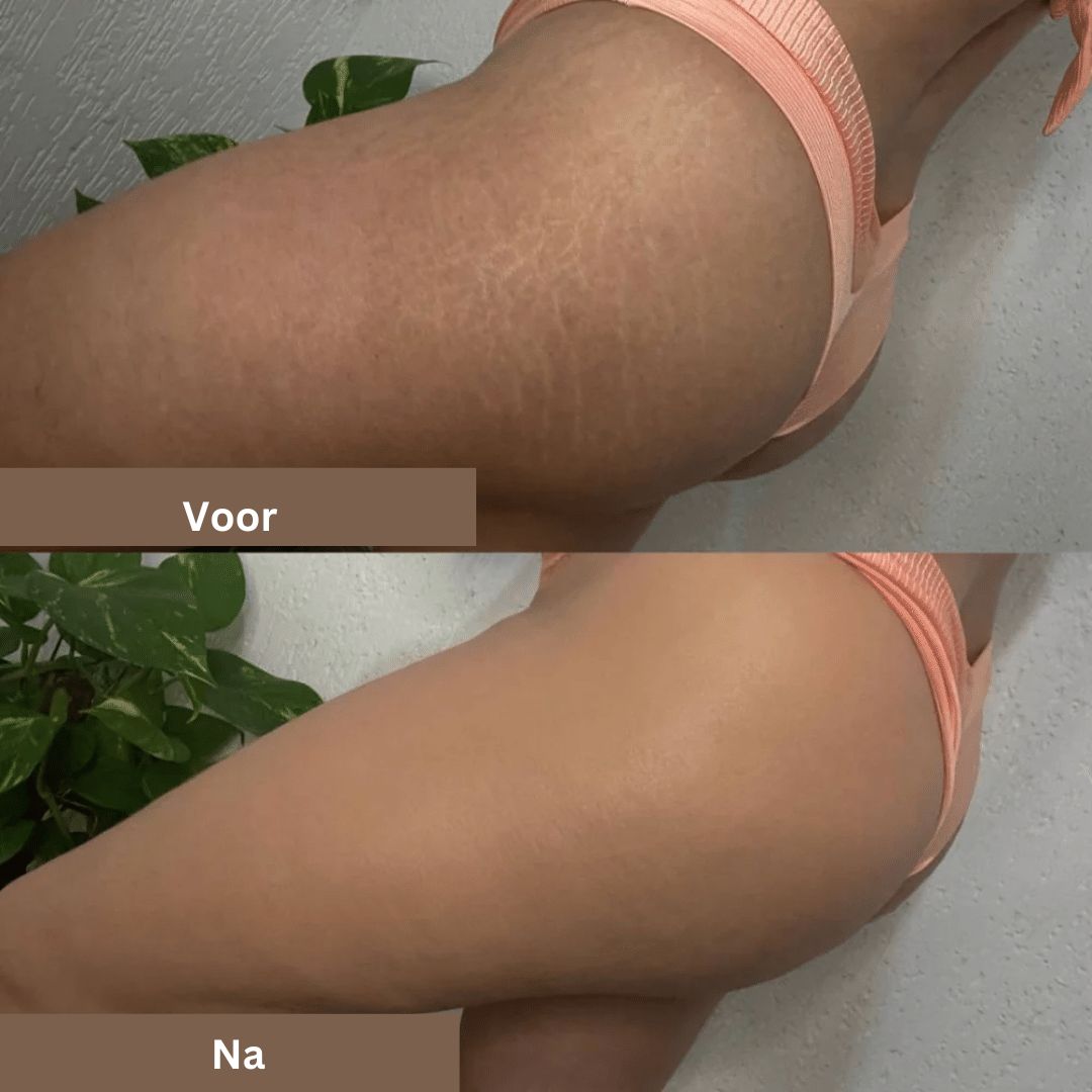 SmoothTone soins de la peau | Pour couvrir les cicatrices, les veines, l'acné et les taches de soleil