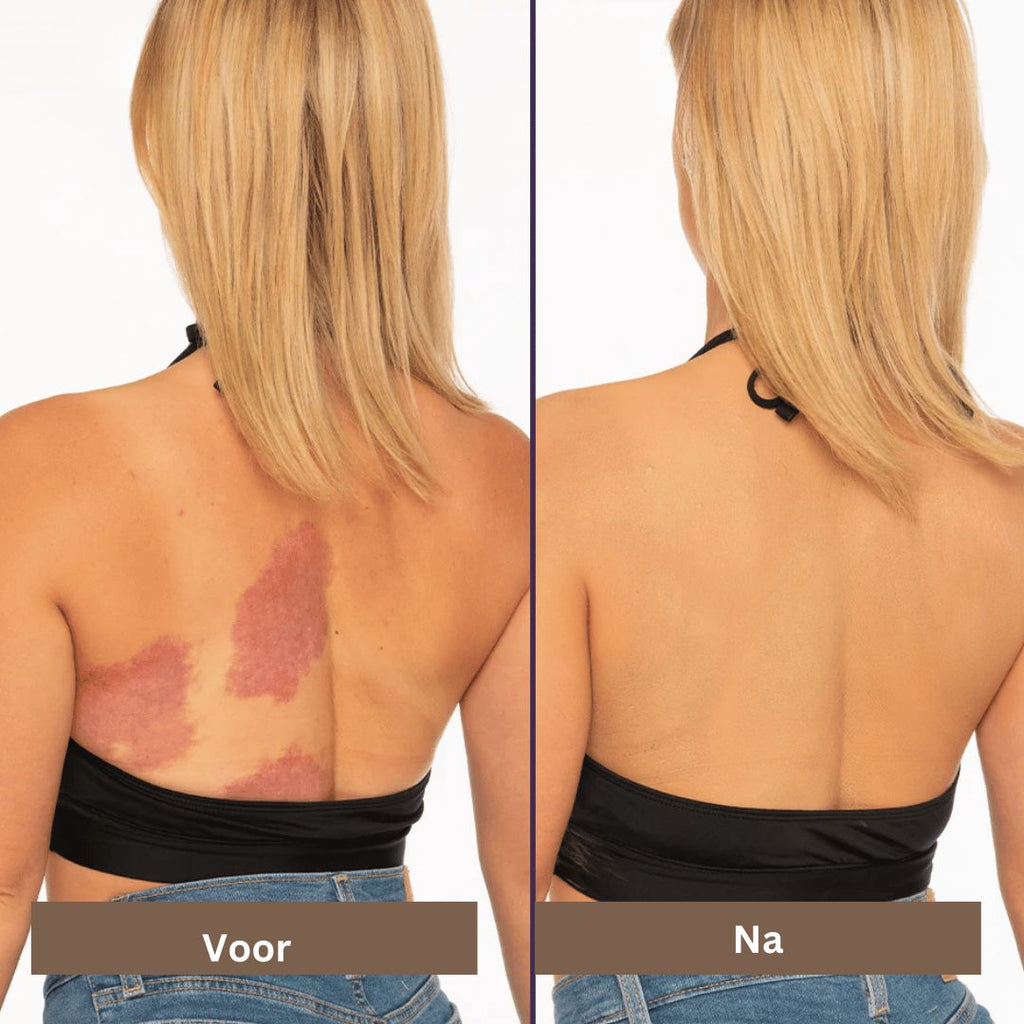 SmoothTone soins de la peau | Pour couvrir les cicatrices, les veines, l'acné et les taches de soleil