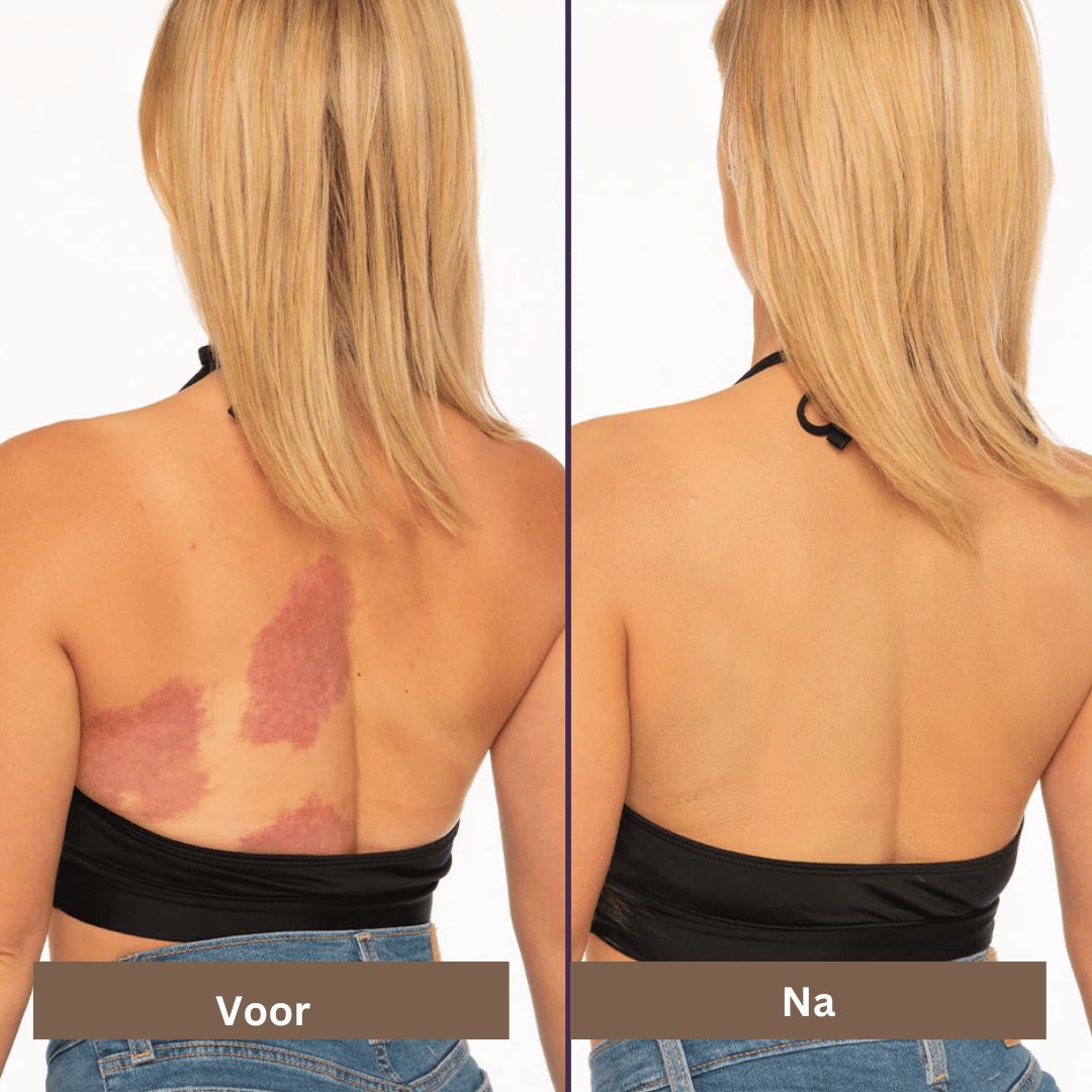 SmoothTone soins de la peau | Pour couvrir les cicatrices, les veines, l'acné et les taches de soleil